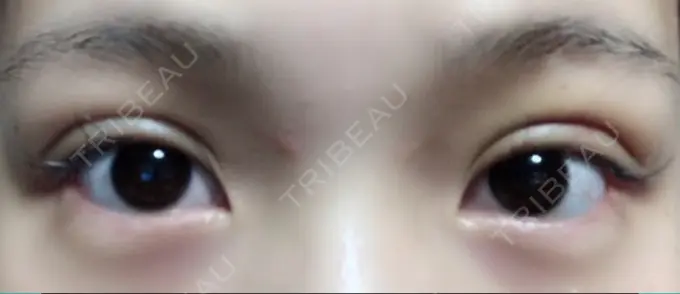 二重埋没 湘南美容クリニック 京都院 DAY 4 メイン用