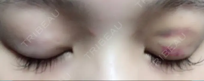 二重埋没 湘南美容クリニック 京都院 DAY 4 メイン用