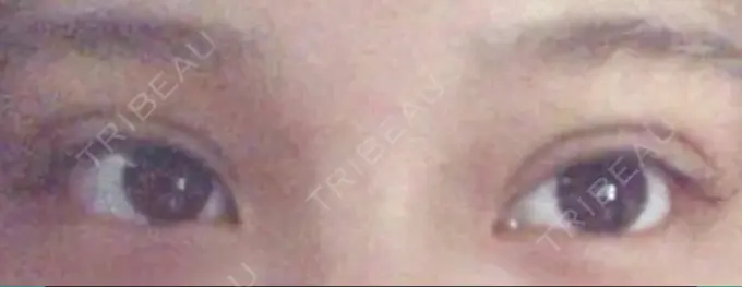 二重埋没 湘南美容クリニック 京都院 DAY 5 メイン用