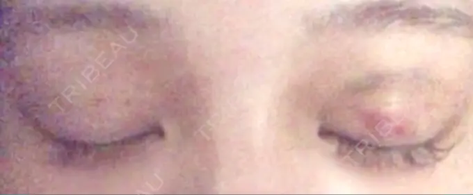 二重埋没 湘南美容クリニック 京都院 DAY 5 メイン用