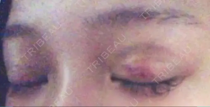 二重埋没 湘南美容クリニック 京都院 DAY 5 メイン用