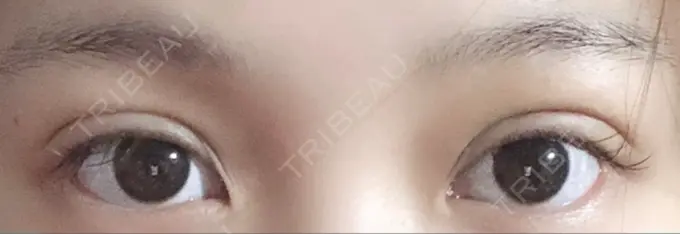 二重埋没 湘南美容クリニック 京都院 AFTER メイン用