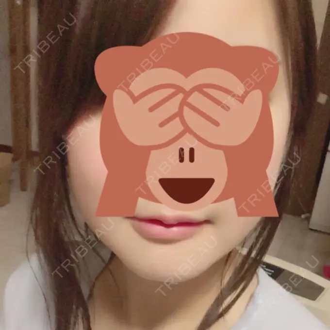 骨切り（あご） / その他（輪郭） マックスファクス銀座クリニック DAY 28 メイン用