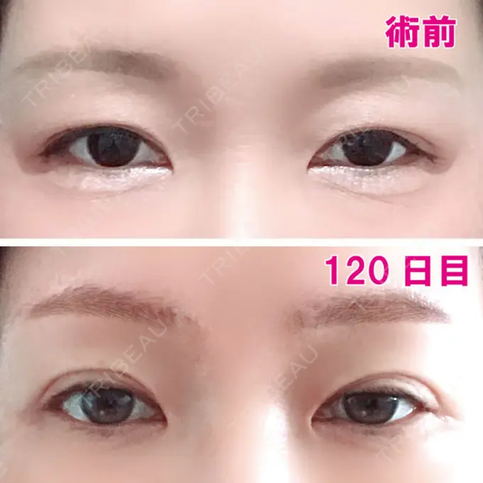 眉下切開 エイペックス美容外科 DAY 120 メイン用