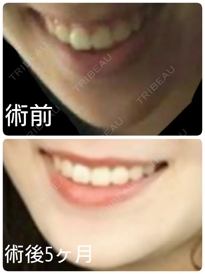 骨切り（あご） / ルフォー+ssro（両あご) id（アイディ）美容外科 AFTER メイン用