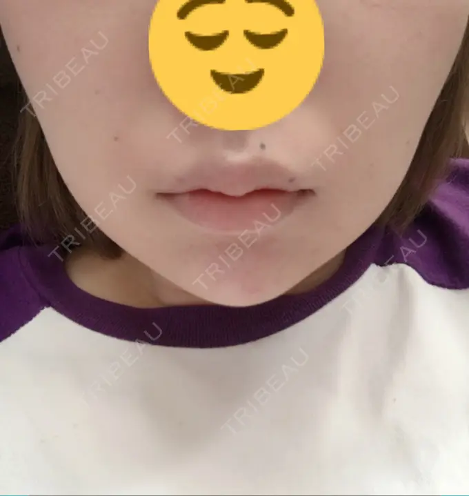 ボトックス（あご） / ヒアルロン酸注入（額） / ハイフ（顔） 湘南美容クリニック 長野院 DAY 1 メイン用