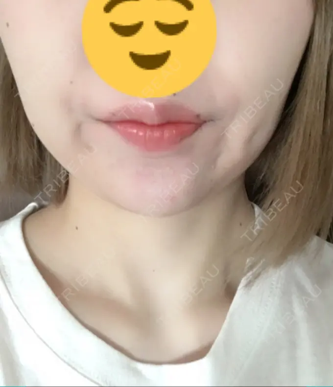 ボトックス（あご） / ヒアルロン酸注入（額） / ハイフ（顔） 湘南美容クリニック 長野院 DAY 1 メイン用