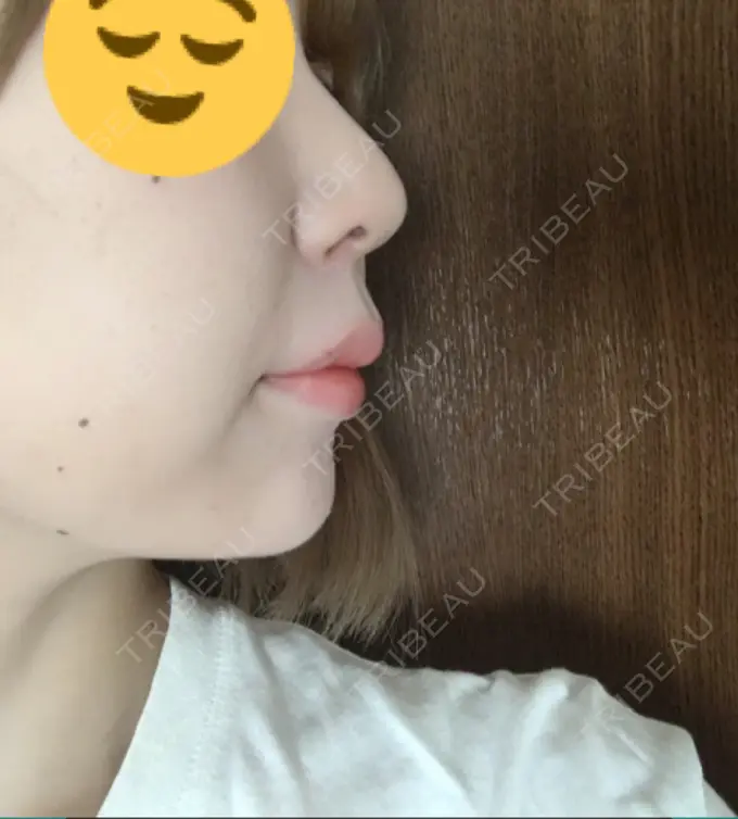 ボトックス（あご） / ヒアルロン酸注入（額） / ハイフ（顔） 湘南美容クリニック 長野院 DAY 1 メイン用