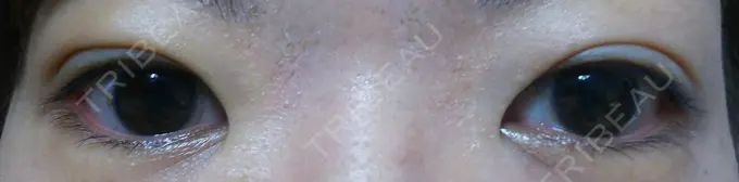 二重埋没 ガーデンクリニック 名古屋院 DAY 4 メイン用