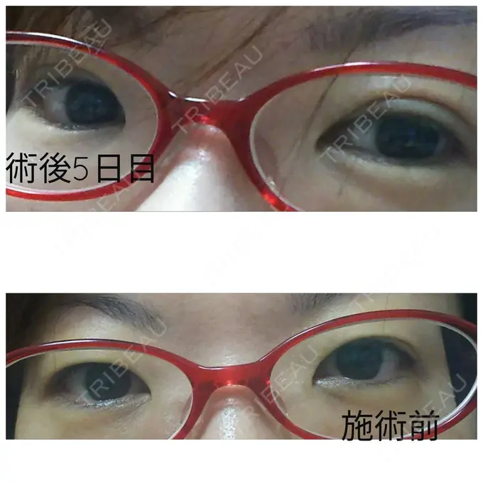 二重埋没 ガーデンクリニック 名古屋院 DAY 5 メイン用