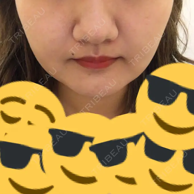 脂肪吸引（顔） アサミ美容外科 渋谷院 DAY 13 メイン用