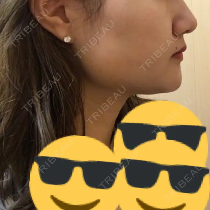 脂肪吸引（顔） アサミ美容外科 渋谷院 DAY 13 メイン用