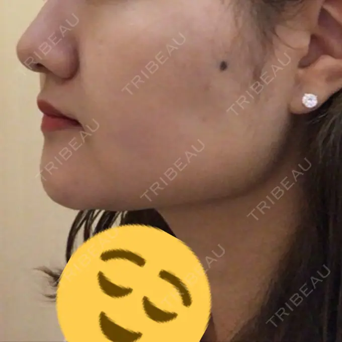 脂肪吸引（顔） アサミ美容外科 渋谷院 DAY 13 メイン用