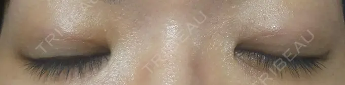 二重埋没 ガーデンクリニック 名古屋院 DAY 7 メイン用