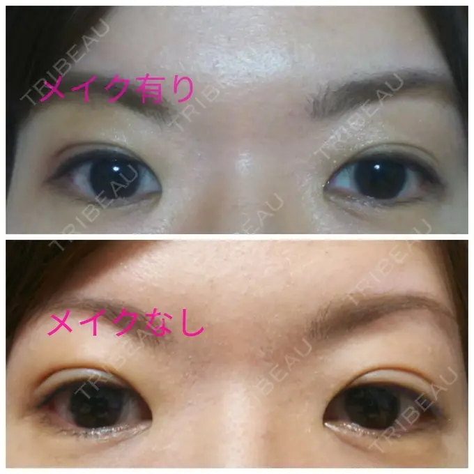 二重埋没 ガーデンクリニック 名古屋院 DAY 8 メイン用