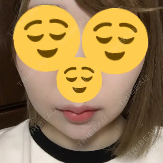 ボトックス（あご） / ヒアルロン酸注入（額） / ハイフ（顔） 湘南美容クリニック 長野院 DAY 2 メイン用