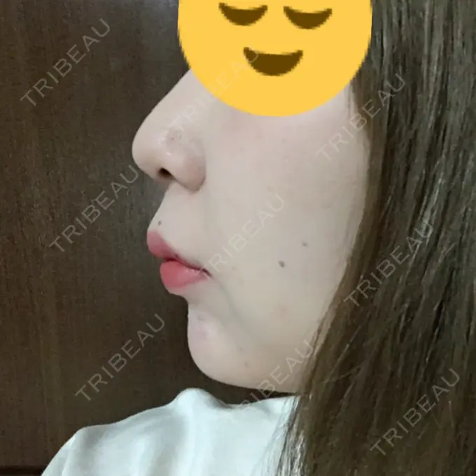 ボトックス（あご） / ヒアルロン酸注入（額） / ハイフ（顔） 湘南美容クリニック 長野院 DAY 2 メイン用