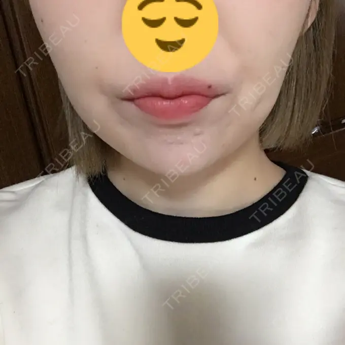 ボトックス（あご） / ヒアルロン酸注入（額） / ハイフ（顔） 湘南美容クリニック 長野院 DAY 2 メイン用