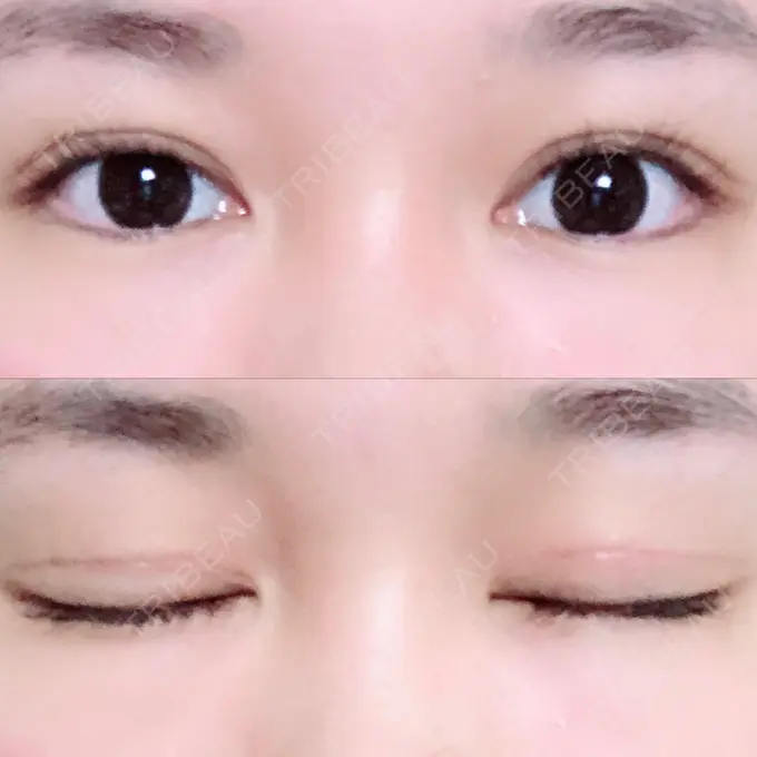 二重切開 / 上まぶたの脂肪取り / その他（目元） 湘南美容クリニック 新宿本院 DAY 60 メイン用