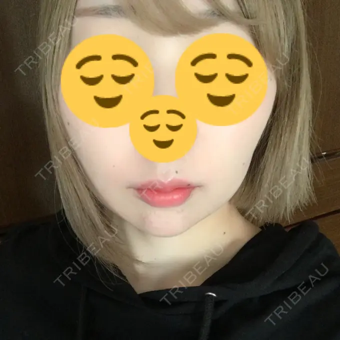 ボトックス（あご） / ヒアルロン酸注入（額） / ハイフ（顔） 湘南美容クリニック 長野院 AFTER メイン用