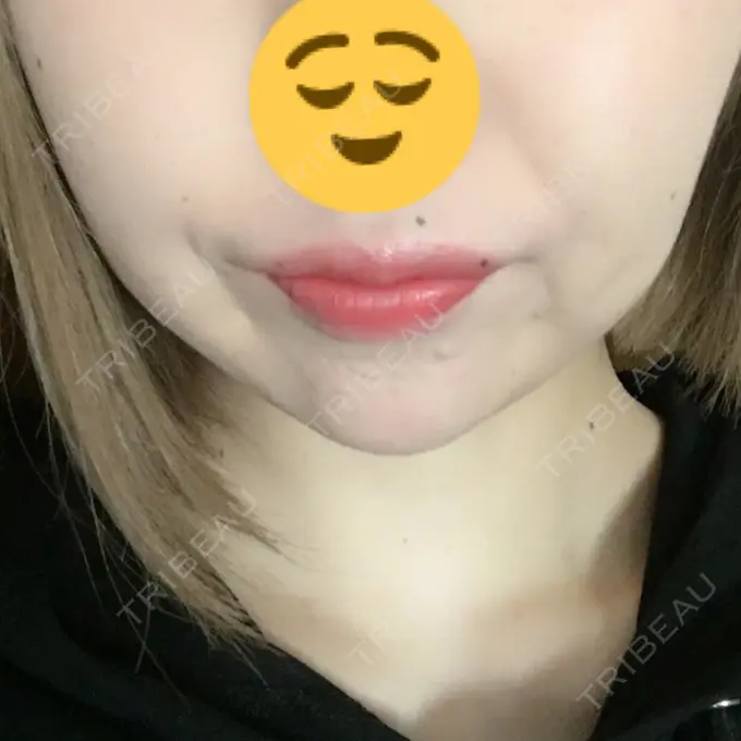 ボトックス（あご） / ヒアルロン酸注入（額） / ハイフ（顔） 湘南美容クリニック 長野院 DAY 3 メイン用