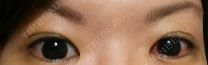 二重埋没 ガーデンクリニック 名古屋院 DAY 10 メイン用