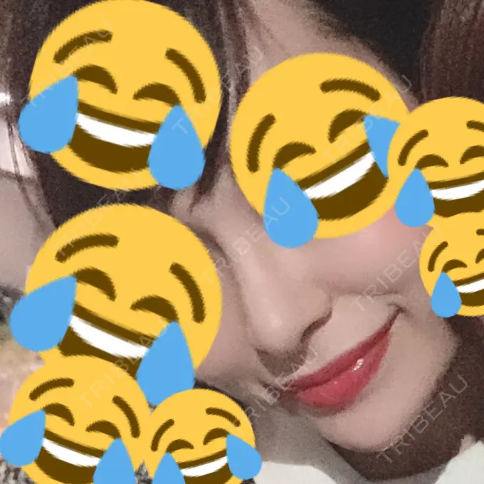 鼻尖形成（切開） / 小鼻縮小（切開） / 軟骨移植 / 骨切幅寄せ / ワシ鼻修正・ハンプ切除 FROM B整形外科 (旧バウム整形外科) DAY 30 メイン用