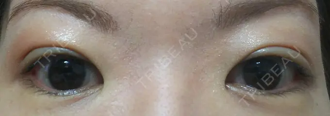 二重埋没 ガーデンクリニック 名古屋院 AFTER メイン用