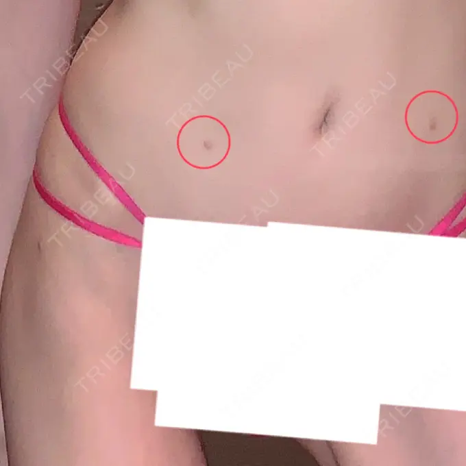 脂肪吸引（二の腕） / 脂肪吸引（お腹） / 脂肪溶解注射（二の腕） / 脂肪溶解注射（お腹） / その他（ボディ） THE SKINNY CLINIC（ザ・スキニークリニック） AFTER メイン用