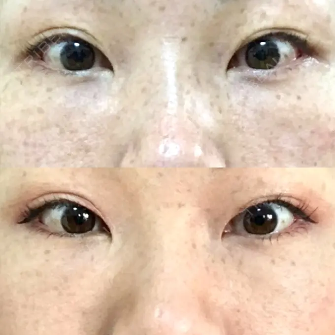 下まぶたたるみ取り / 下まぶたの脂肪取り 韓国ST美容整形外科 DAY 99 メイン用