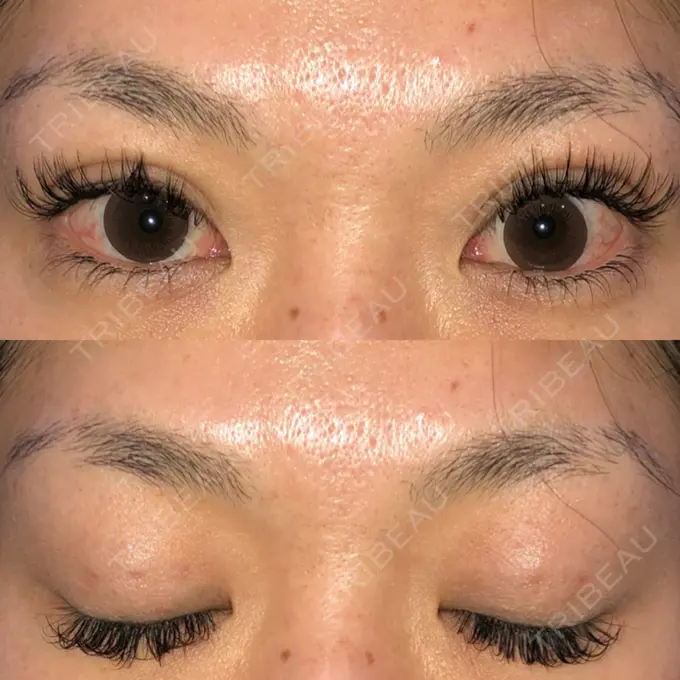 二重埋没 湘南美容クリニック 京都院 AFTER メイン用