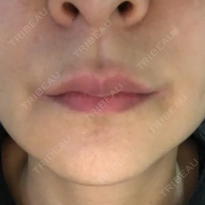 ルフォー+ssro（両あご) id（アイディ）美容外科 DAY 97 メイン用