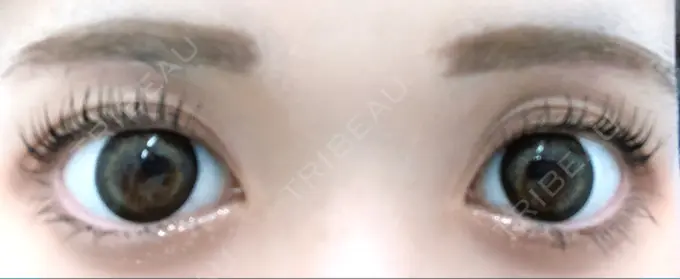 眉下切開 / その他（目元） 湘南美容クリニック 秋葉原院 DAY 30 メイン用