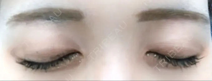 眉下切開 / その他（目元） 湘南美容クリニック 秋葉原院 DAY 30 メイン用