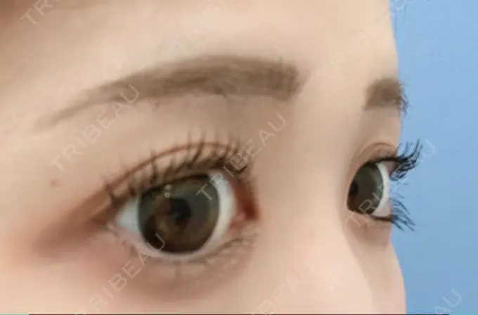 眉下切開 / その他（目元） 湘南美容クリニック 秋葉原院 DAY 30 メイン用