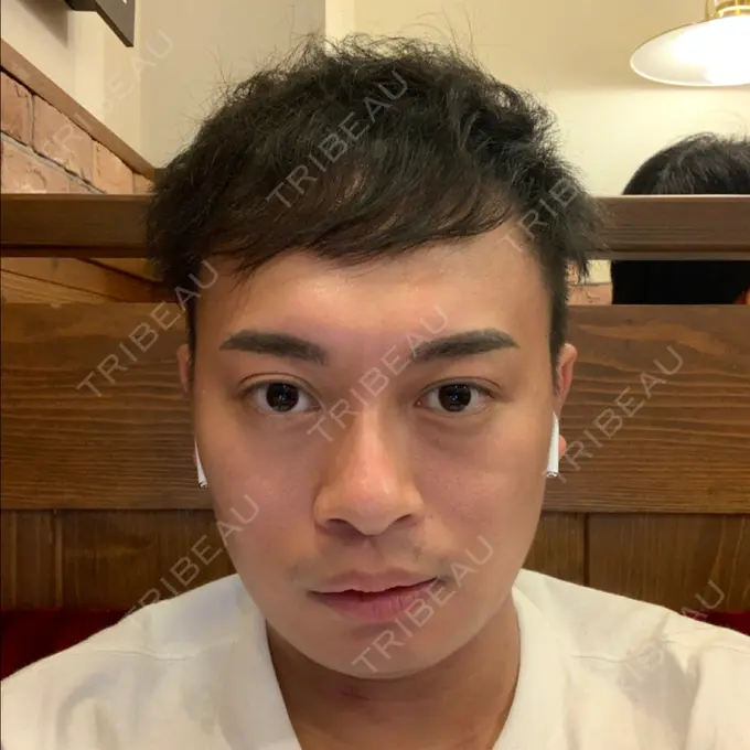 その他（輪郭） スタート整形外科 DAY 34 メイン用