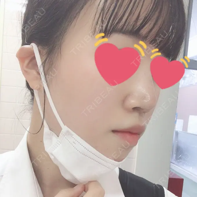 ヒアルロン酸注入（鼻） 東京ヒルズクリニック 岡崎院 DAY 2 メイン用