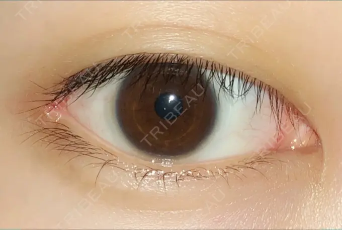 目頭切開 / 目尻切開 エートップ美容整形外科 DAY 102 メイン用