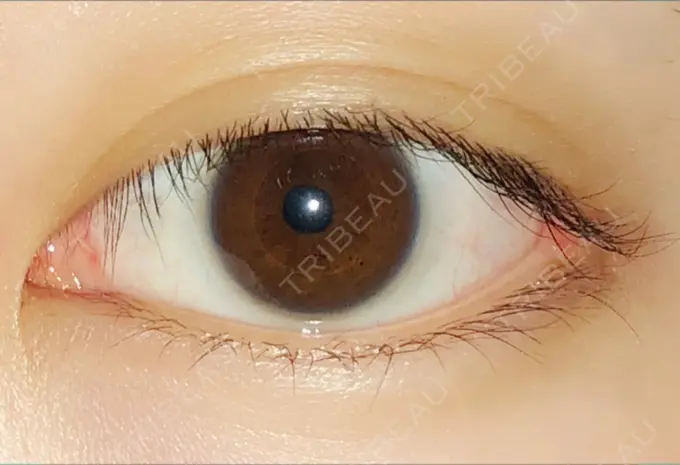 目頭切開 / 目尻切開 エートップ美容整形外科 DAY 102 メイン用