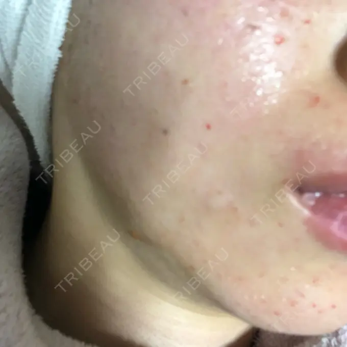 水光注射（ハリ・美肌） Wクリニック 心斎橋院 DAY 0 メイン用