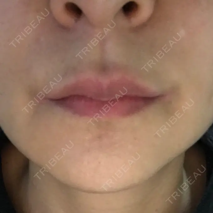 ルフォー+ssro（両あご) id（アイディ）美容外科 DAY 97 メイン用