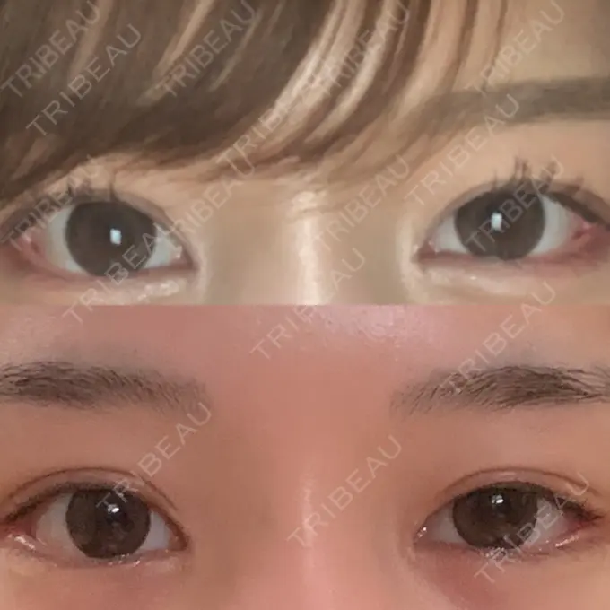 目頭切開 / 目尻切開 新宿ラクル美容外科クリニック 新宿院 AFTER メイン用