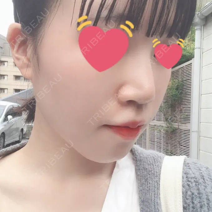 ヒアルロン酸注入（鼻） 東京ヒルズクリニック 岡崎院 DAY 3 メイン用