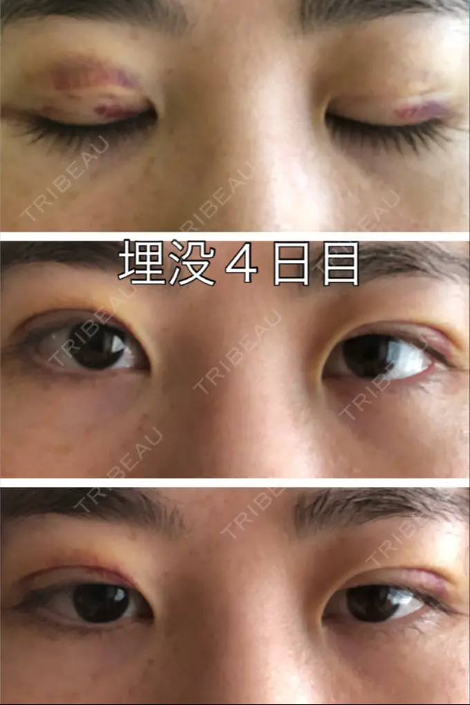 二重埋没 新宿美容外科クリニック 立川院 DAY 3 メイン用