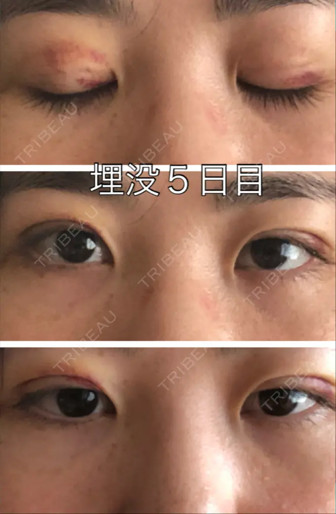 二重埋没 新宿美容外科クリニック 立川院 DAY 4 メイン用