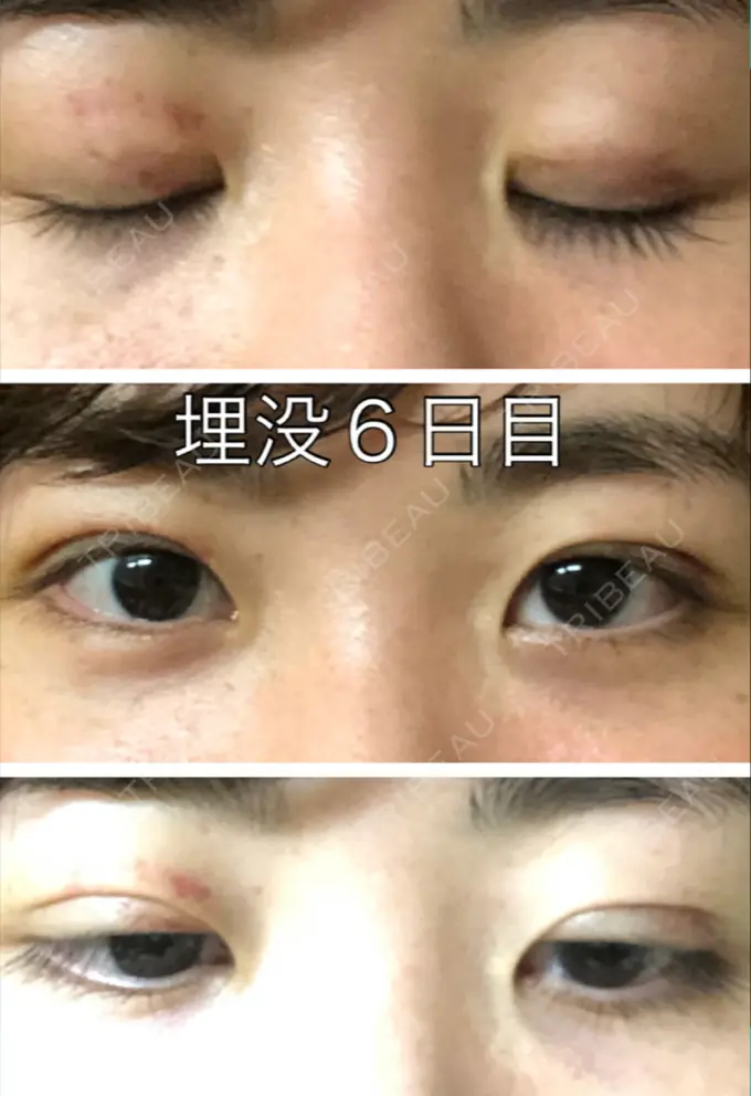 二重埋没 新宿美容外科クリニック 立川院 DAY 5 メイン用