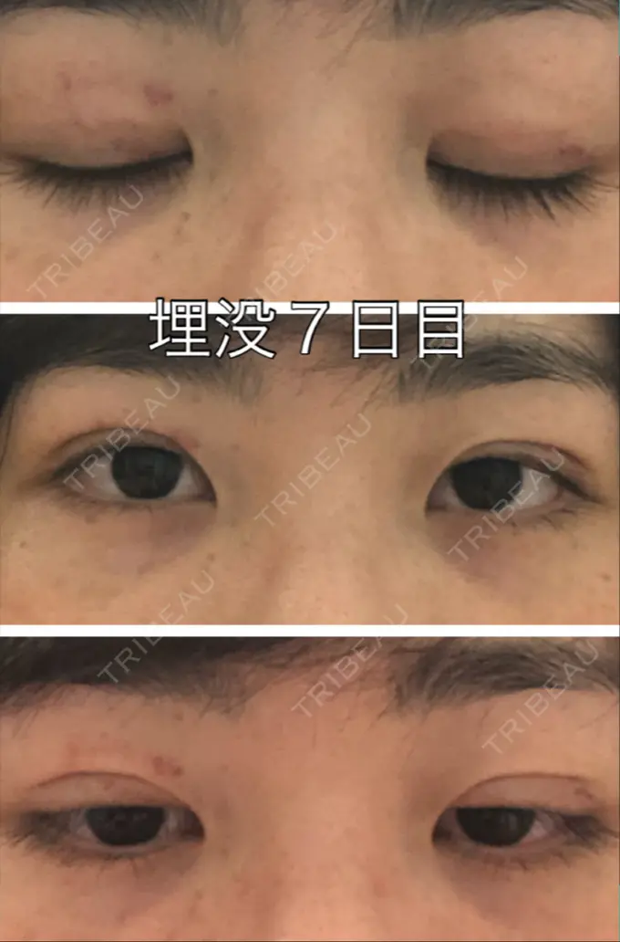 二重埋没 新宿美容外科クリニック 立川院 DAY 6 メイン用