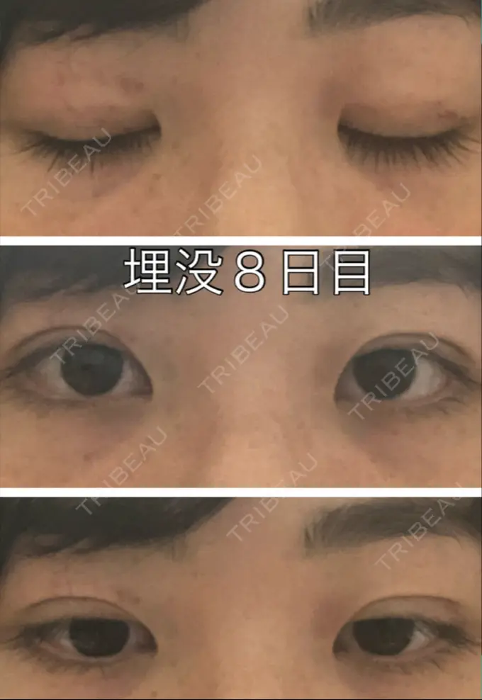 二重埋没 新宿美容外科クリニック 立川院 DAY 7 メイン用