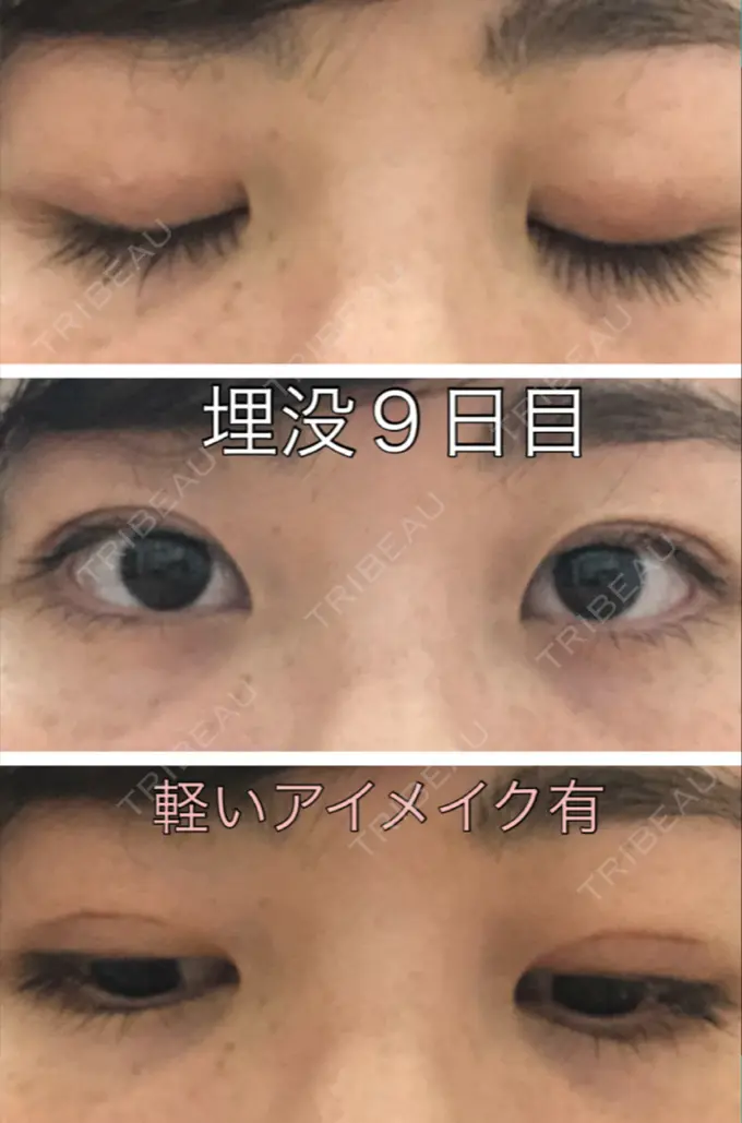 二重埋没 新宿美容外科クリニック 立川院 DAY 8 メイン用