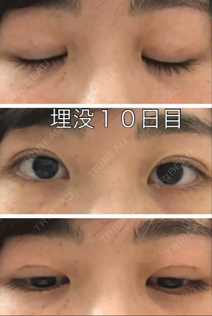 二重埋没 新宿美容外科クリニック 立川院 DAY 9 メイン用